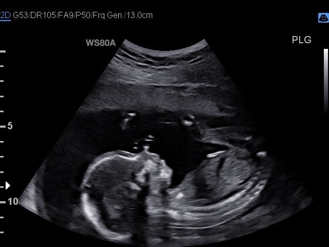 baby ultrasound profile